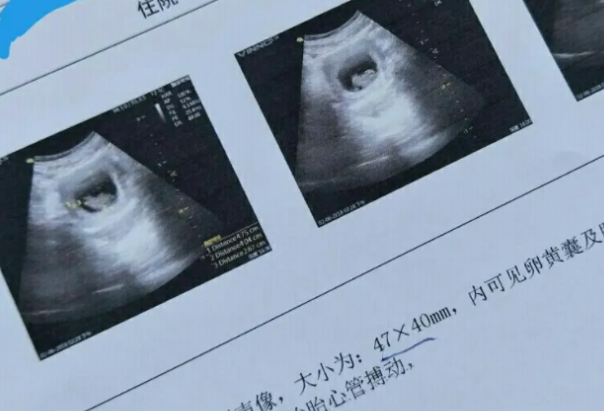 怀孕早期B超显示孕囊33x19x38是男娃几率大还是女娃概率高？