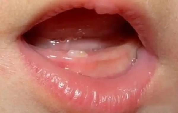 单出牙只是一种正常的生理现象