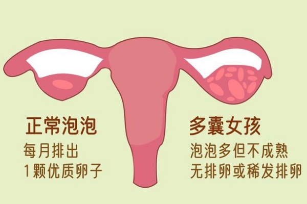 多囊患者会影响促排卵次数