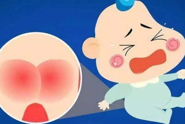 宝宝有红屁股是纸尿裤过敏