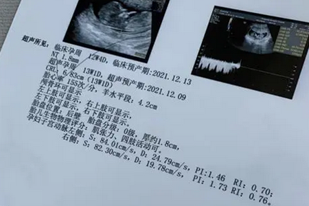 nt值偏高和染色体异常有关